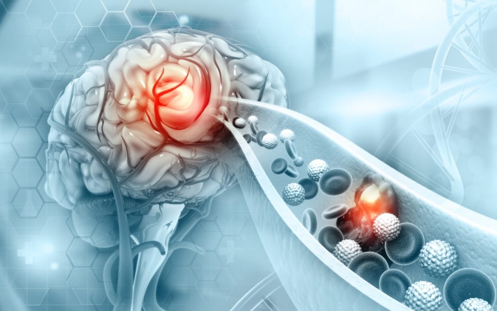 Atherosclerosis Stroke. A blood clot in the vessels of the human brain