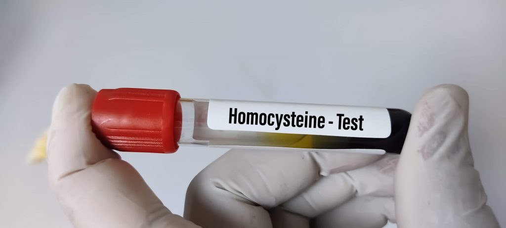 Blood sample tube for Homocysteine test at medical laboratory.